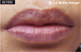 リップホワイトニングセッション前1